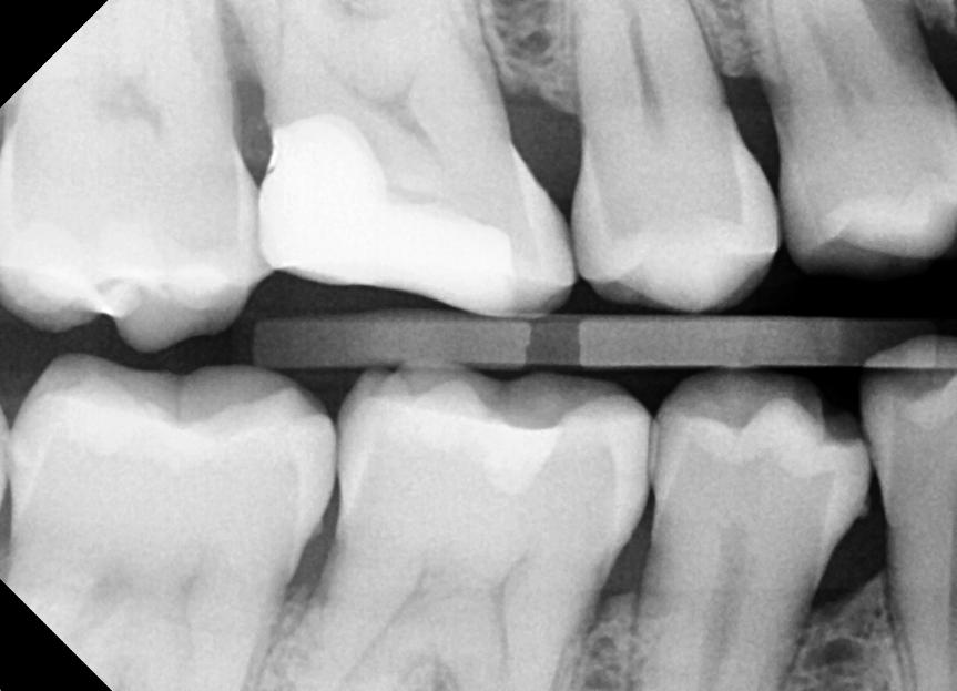 Dental Check Up Benefits Cracked Tooth Fixed | Nolan Ridge Dental | NW Calgary | General and Family Dentist