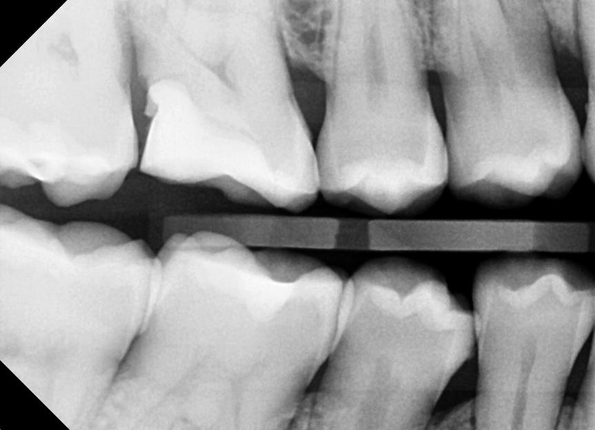 Dental Check Up Benefits Cracked Tooth | Nolan Ridge Dental | NW Calgary | General and Family Dentist