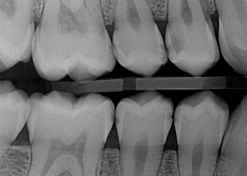 Dental Check Up Prevent Dental Tooth Decay | Nolan Ridge Dental | NW Calgary | General and Family Dentist