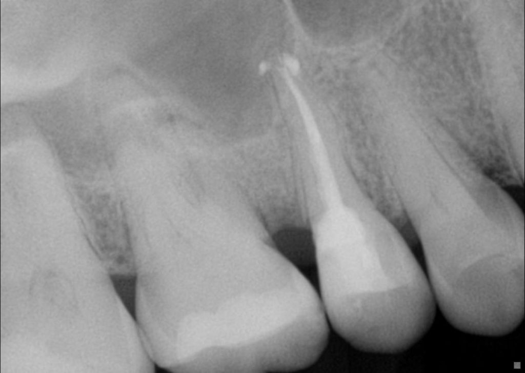 Dental Check Up Prevent After Root Canal Treatment | Nolan Ridge Dental | NW Calgary | General and Family Dentist