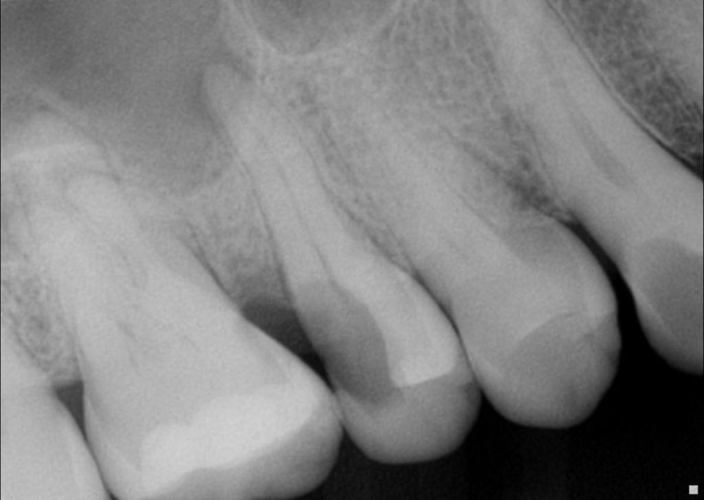 Dental Check Up Prevent Before Root Canal Treatment | Nolan Ridge Dental | NW Calgary | General and Family Dentist