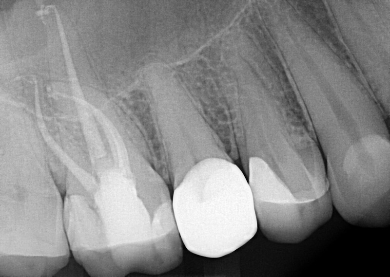 Endodontics Dental Services After Treatment | Nolan Ridge Dental | NW Calgary | General and Family Dentist
