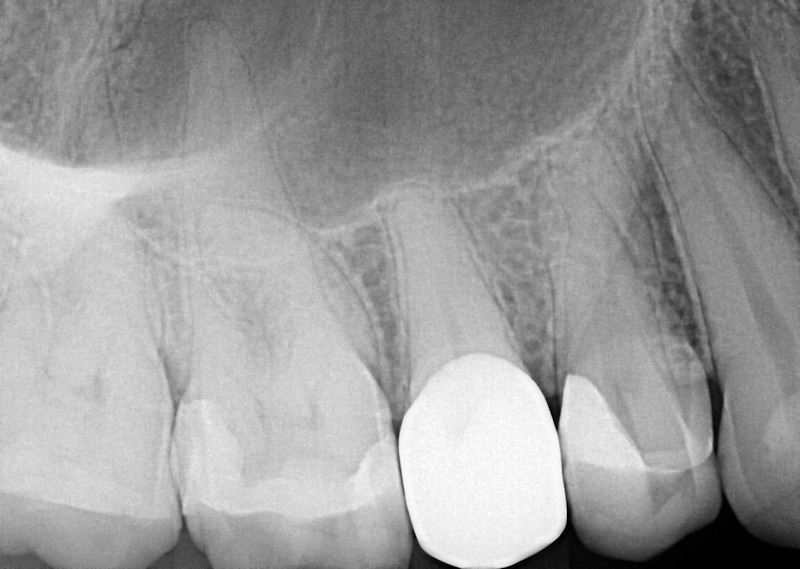 Endodontic Dental Services Before Treatment | Nolan Ridge Dental | NW Calgary | General and Family Dentist