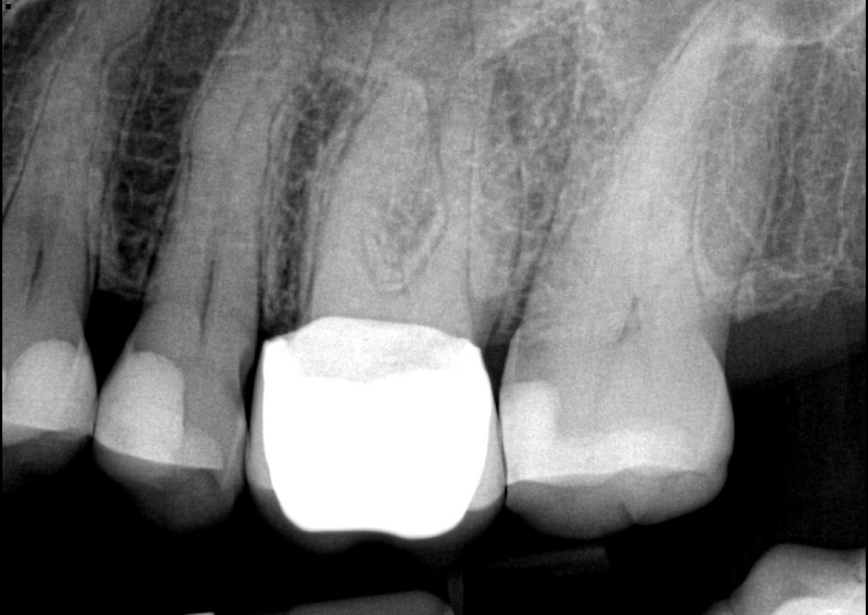 Endodontics Root Canal Crown Before Retreatment | Nolan Ridge Dental | NW Calgary | General and Family Dentist