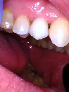 Dental Implant and Crown Placed | Nolan Ridge Dental | NW Calgary AB| General and Family Dentist