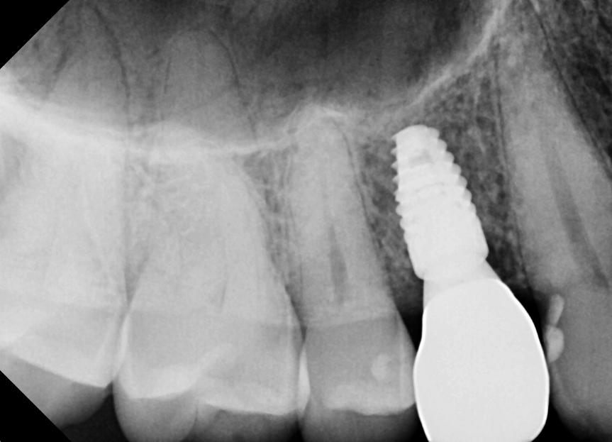 Dental Implant and Crown Placed X-Ray | Nolan Ridge Dental | NW Calgary AB| General and Family Dentist