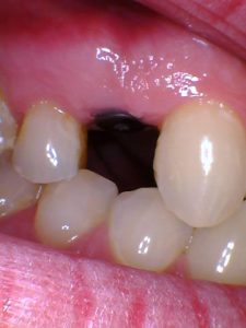 Dental Implant Placed with Healing Abutment | Nolan Ridge Dental | NW Calgary | General and Family Dentist