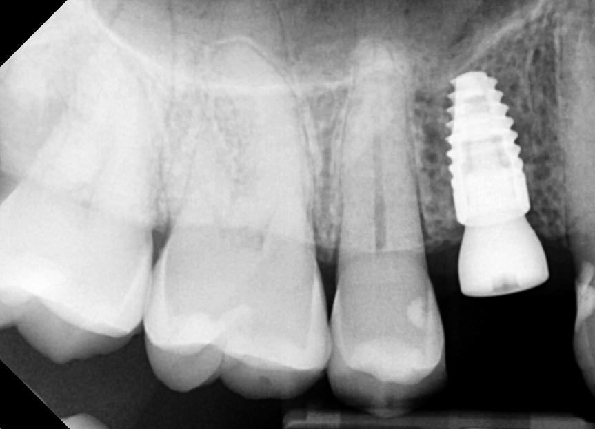 Dental Implant Placed with Healing Abutment X-Ray | Nolan Ridge Dental | NW Calgary | General and Family Dentist