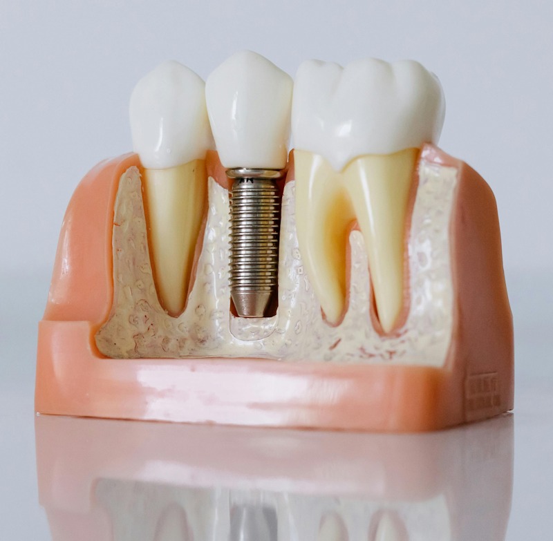 Dental Implants Services